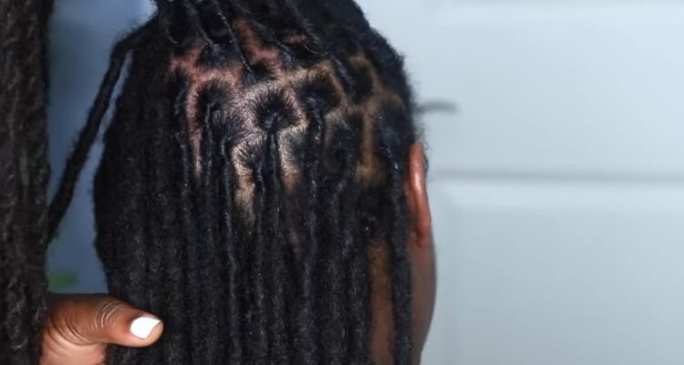 How To Treat Dandruff On Dreadlocks