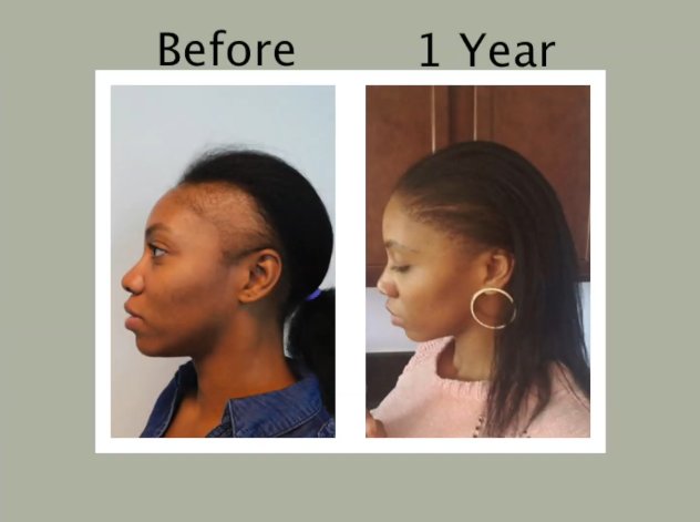 How To Prevent Traction Alopecia