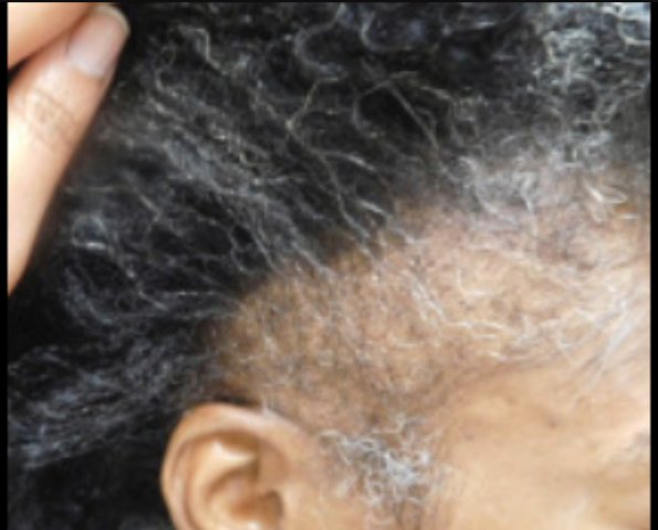 What is Traction Alopecia